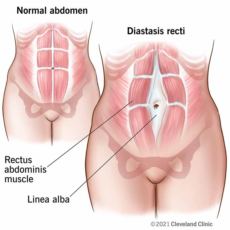 abdomen for diastasis recti postpartum
